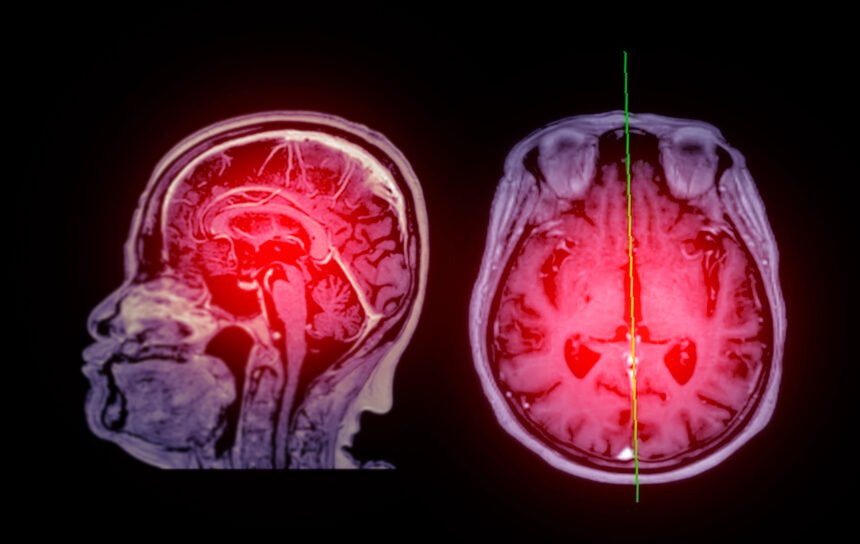 Pesquisa indica primeiro sinal de Alzheimer que aparece ao caminhar