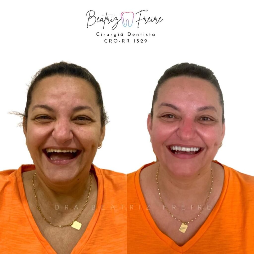 Facetas em Resina por Dra. Beatriz Freire